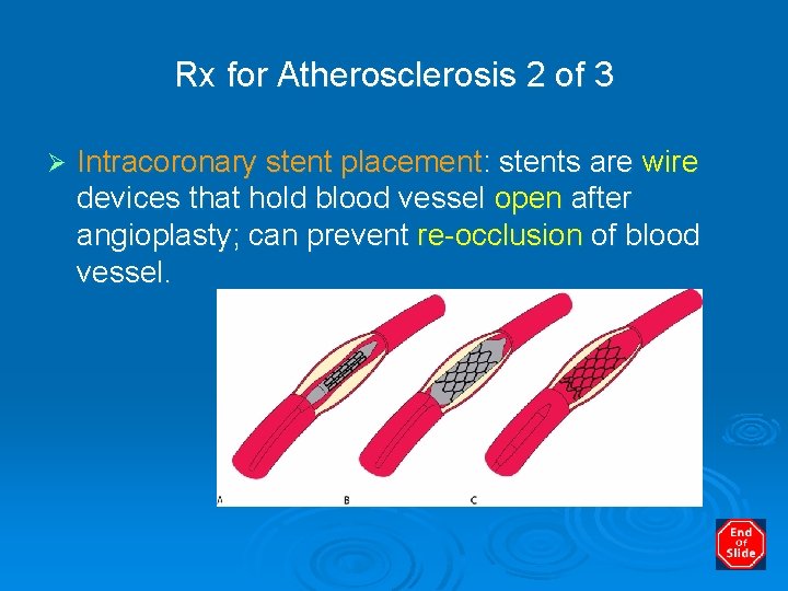 Rx for Atherosclerosis 2 of 3 Ø Intracoronary stent placement: stents are wire devices
