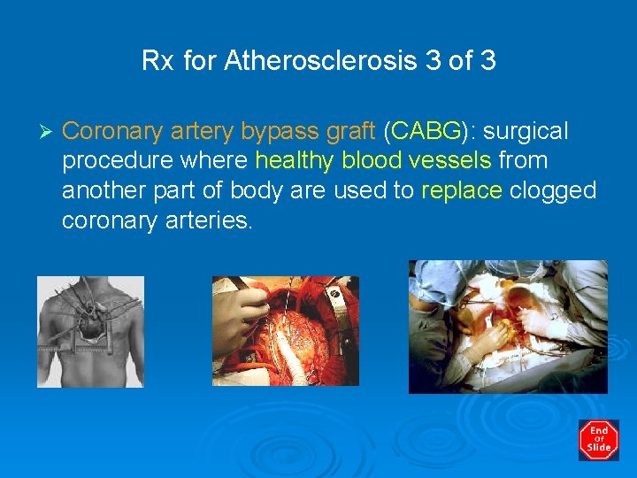 Rx for Atherosclerosis 3 of 3 Ø Coronary artery bypass graft (CABG): surgical procedure