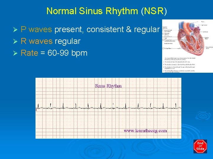 Normal Sinus Rhythm (NSR) P waves present, consistent & regular Ø R waves regular