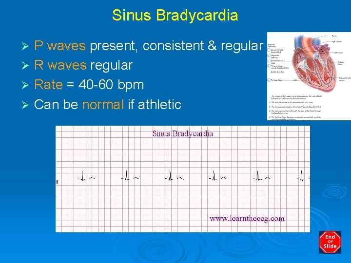 Sinus Bradycardia P waves present, consistent & regular Ø R waves regular Ø Rate