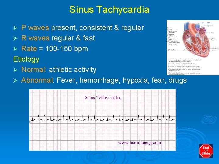 Sinus Tachycardia P waves present, consistent & regular Ø R waves regular & fast