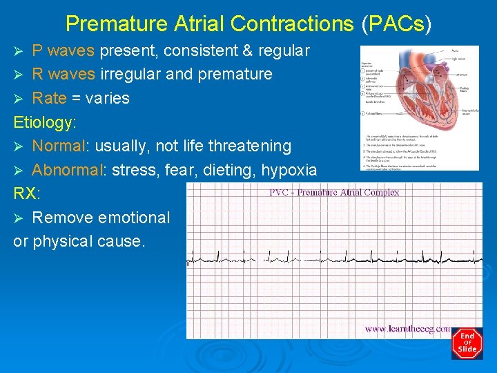 Premature Atrial Contractions (PACs) P waves present, consistent & regular Ø R waves irregular