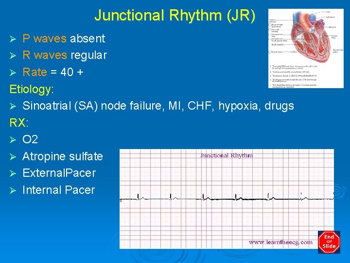 Junctional Rhythm (JR) P waves absent Ø R waves regular Ø Rate = 40