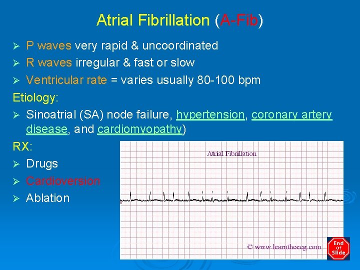 Atrial Fibrillation (A-Fib) P waves very rapid & uncoordinated Ø R waves irregular &