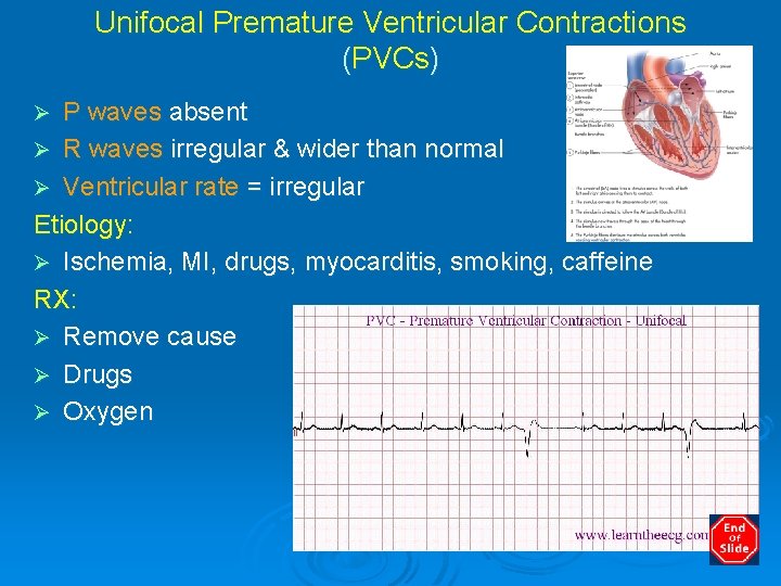 Unifocal Premature Ventricular Contractions (PVCs) P waves absent Ø R waves irregular & wider