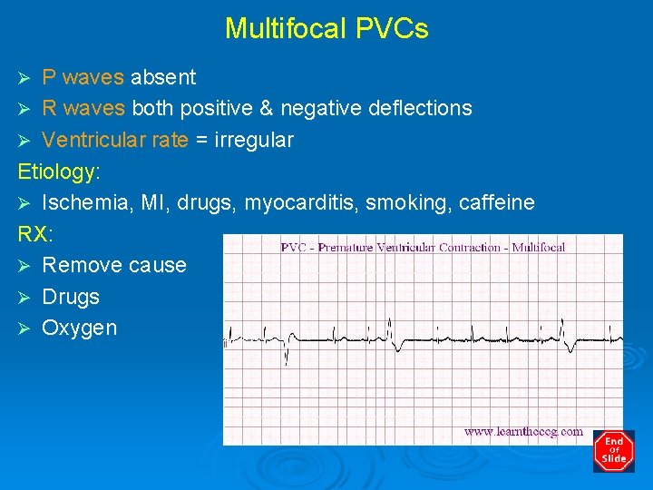 Multifocal PVCs P waves absent Ø R waves both positive & negative deflections Ø