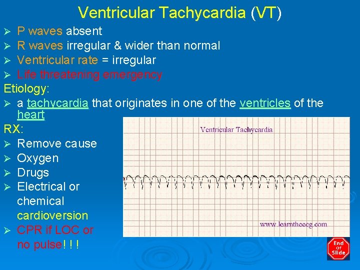 Ventricular Tachycardia (VT) P waves absent R waves irregular & wider than normal Ventricular