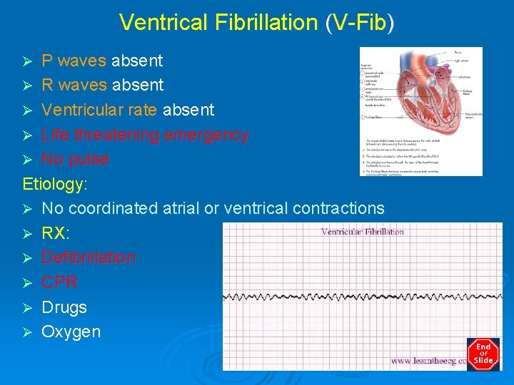 Ventrical Fibrillation (V-Fib) P waves absent Ø R waves absent Ø Ventricular rate absent