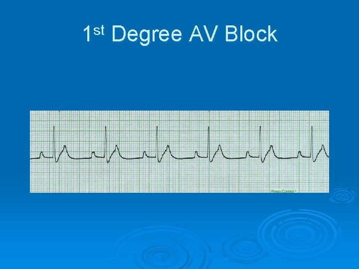 1 st Degree AV Block 