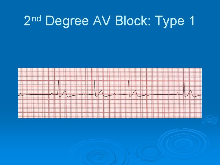 2 nd Degree AV Block: Type 1 