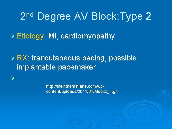 2 nd Degree AV Block: Type 2 Ø Etiology: MI, cardiomyopathy Ø RX: trancutaneous