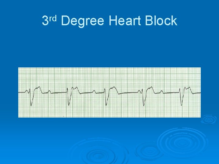 3 rd Degree Heart Block 