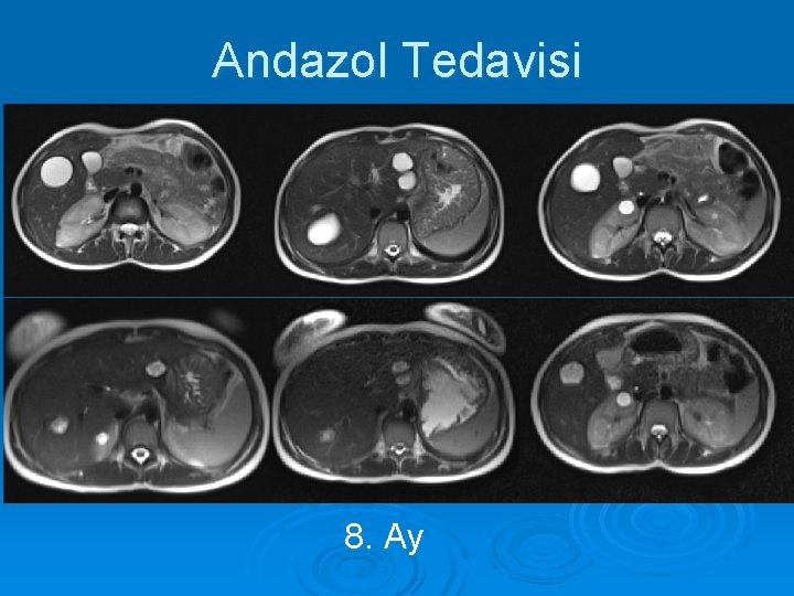 Andazol Tedavisi 15 YK 8. Ay 