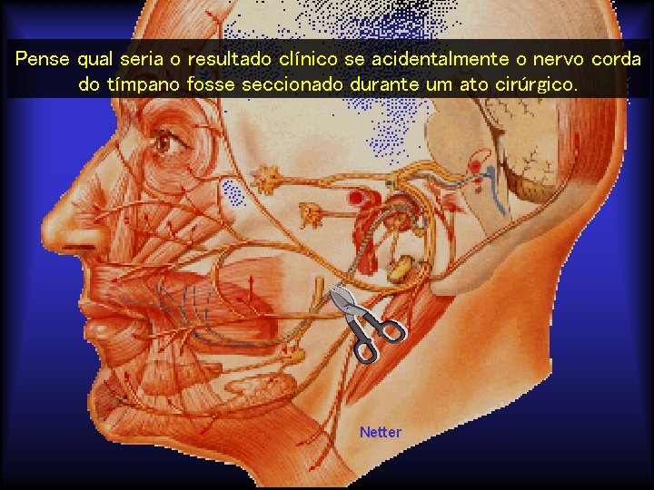 Pense qual seria o resultado clínico se acidentalmente o nervo corda do tímpano fosse