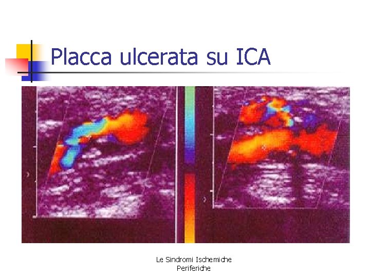 Placca ulcerata su ICA Le Sindromi Ischemiche Periferiche Placca ulcerata su ICA Le Sindromi Ischemiche Periferiche