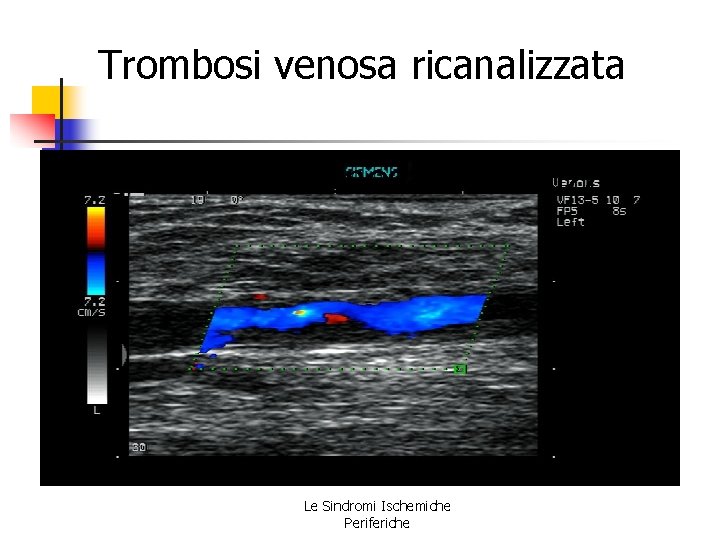 Trombosi venosa ricanalizzata Le Sindromi Ischemiche Periferiche Trombosi venosa ricanalizzata Le Sindromi Ischemiche Periferiche