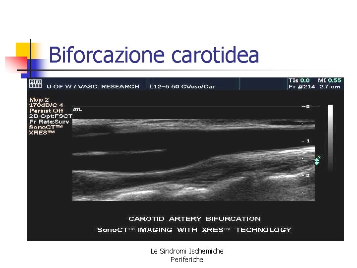 Biforcazione carotidea Le Sindromi Ischemiche Periferiche Biforcazione carotidea Le Sindromi Ischemiche Periferiche
