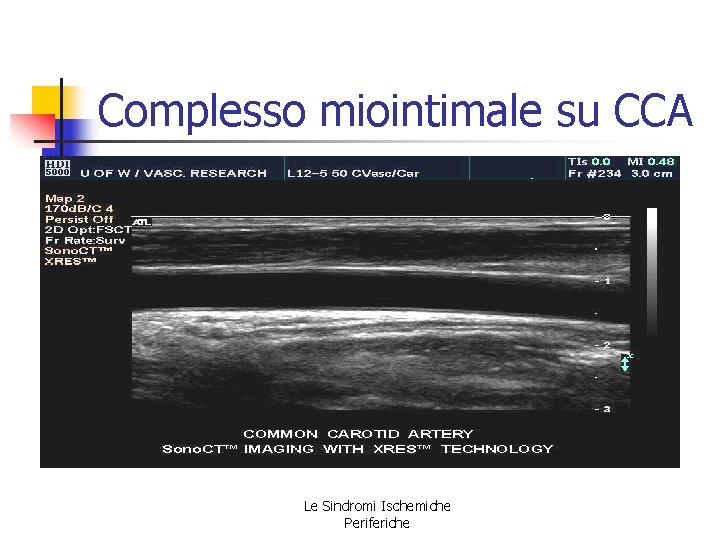 Complesso miointimale su CCA Le Sindromi Ischemiche Periferiche Complesso miointimale su CCA Le Sindromi Ischemiche Periferiche