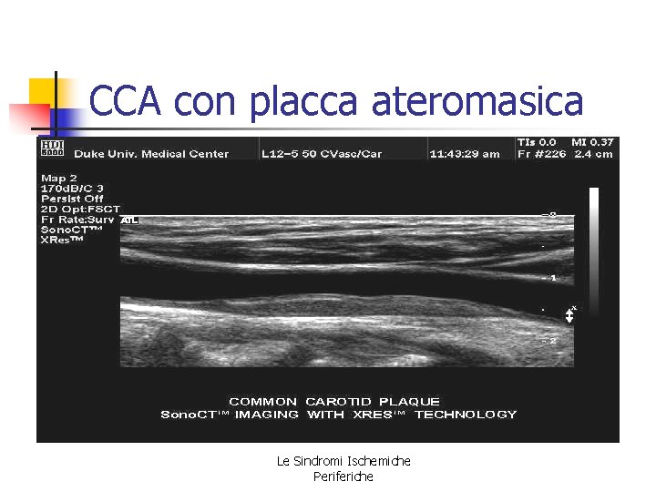 CCA con placca ateromasica Le Sindromi Ischemiche Periferiche CCA con placca ateromasica Le Sindromi Ischemiche Periferiche