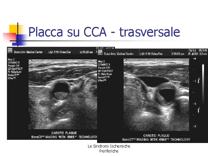 Placca su CCA - trasversale Le Sindromi Ischemiche Periferiche Placca su CCA - trasversale Le Sindromi Ischemiche Periferiche