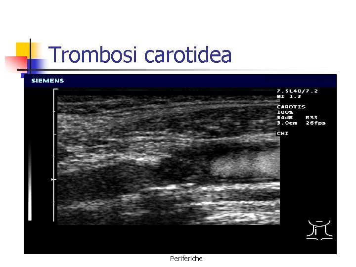 Trombosi carotidea Le Sindromi Ischemiche Periferiche Trombosi carotidea Le Sindromi Ischemiche Periferiche