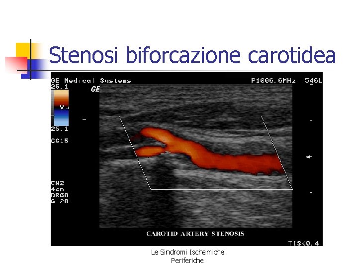 Stenosi biforcazione carotidea Le Sindromi Ischemiche Periferiche Stenosi biforcazione carotidea Le Sindromi Ischemiche Periferiche