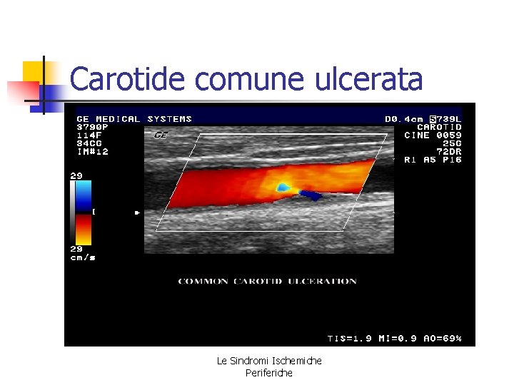 Carotide comune ulcerata Le Sindromi Ischemiche Periferiche Carotide comune ulcerata Le Sindromi Ischemiche Periferiche