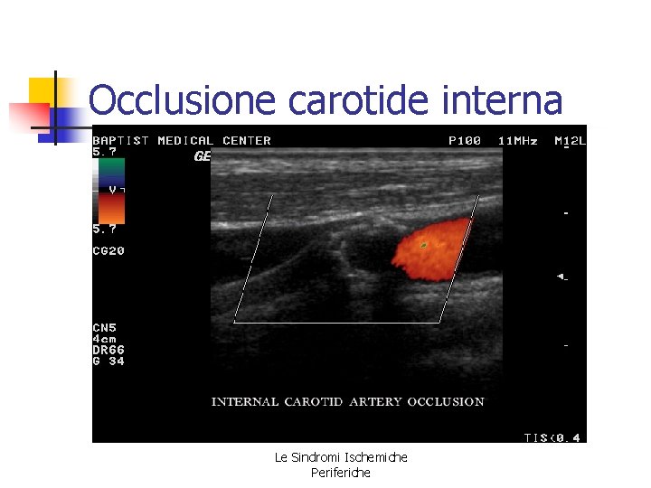 Occlusione carotide interna Le Sindromi Ischemiche Periferiche Occlusione carotide interna Le Sindromi Ischemiche Periferiche