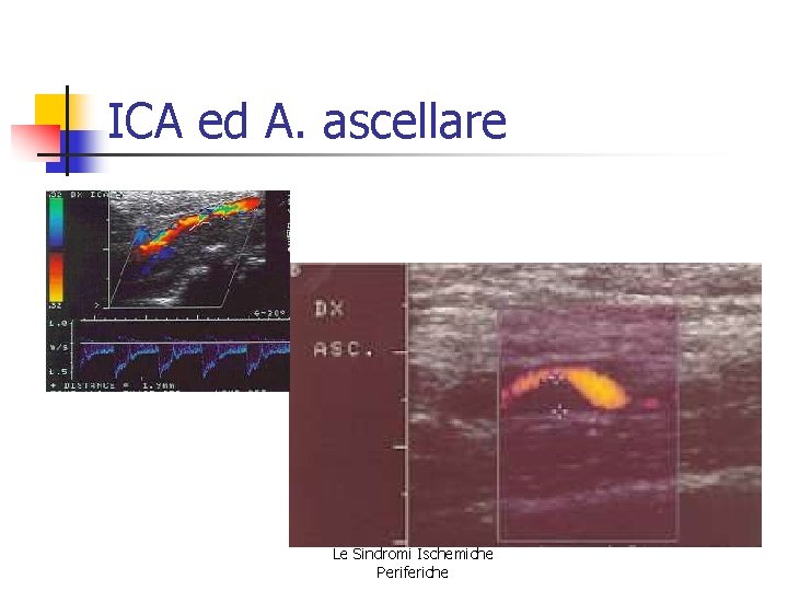 ICA ed A. ascellare Le Sindromi Ischemiche Periferiche ICA ed A. ascellare Le Sindromi Ischemiche Periferiche