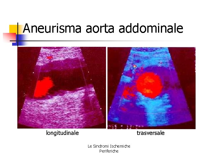 Aneurisma aorta addominale longitudinale trasversale Le Sindromi Ischemiche Periferiche Aneurisma aorta addominale longitudinale trasversale Le Sindromi Ischemiche Periferiche