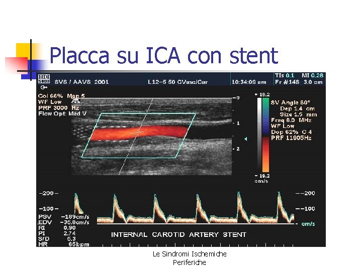 Placca su ICA con stent Le Sindromi Ischemiche Periferiche Placca su ICA con stent Le Sindromi Ischemiche Periferiche