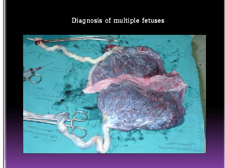 Diagnosis of multiple fetuses 