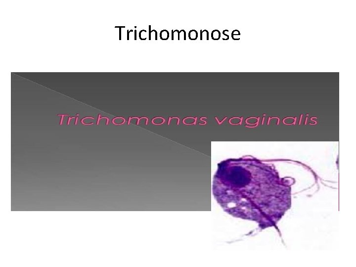 Trichomonose 