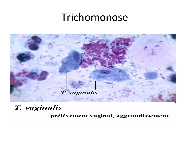 Trichomonose 