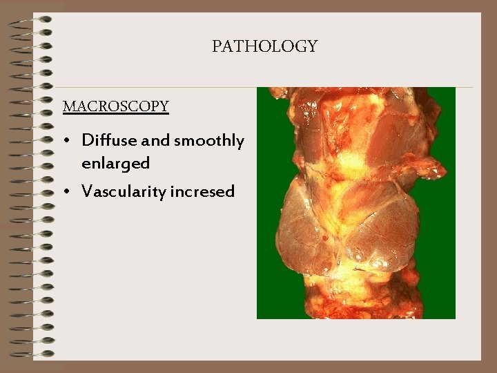 PATHOLOGY MACROSCOPY • Diffuse and smoothly enlarged • Vascularity incresed 