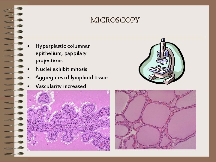 MICROSCOPY • Hyperplastic columnar epithelium, pappilary projections. • Nuclei exhibit mitosis • Aggregates of