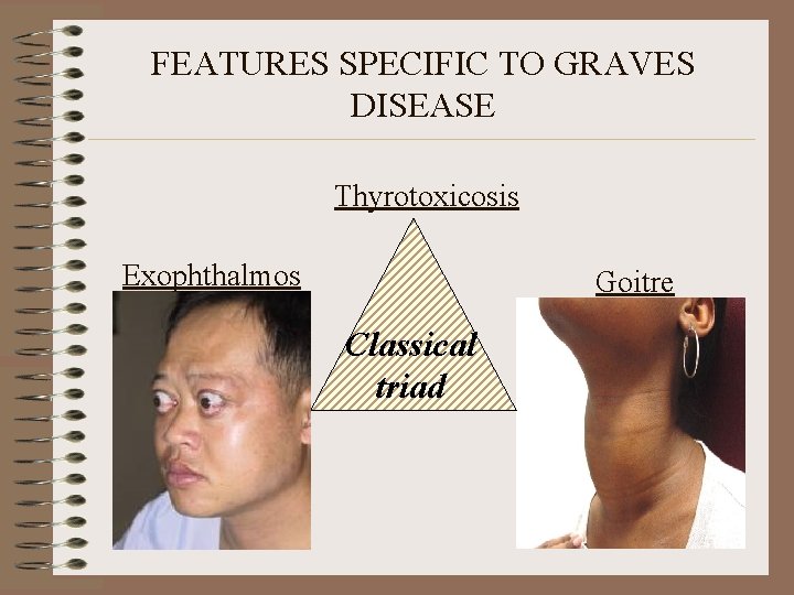 FEATURES SPECIFIC TO GRAVES DISEASE Thyrotoxicosis Exophthalmos Goitre Classical triad 
