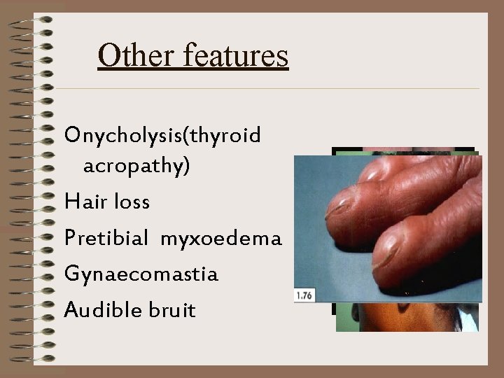 Other features Onycholysis(thyroid acropathy) Hair loss Pretibial myxoedema Gynaecomastia Audible bruit 