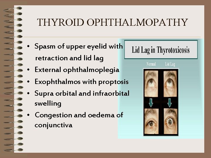 THYROID OPHTHALMOPATHY • Spasm of upper eyelid with retraction and lid lag • External