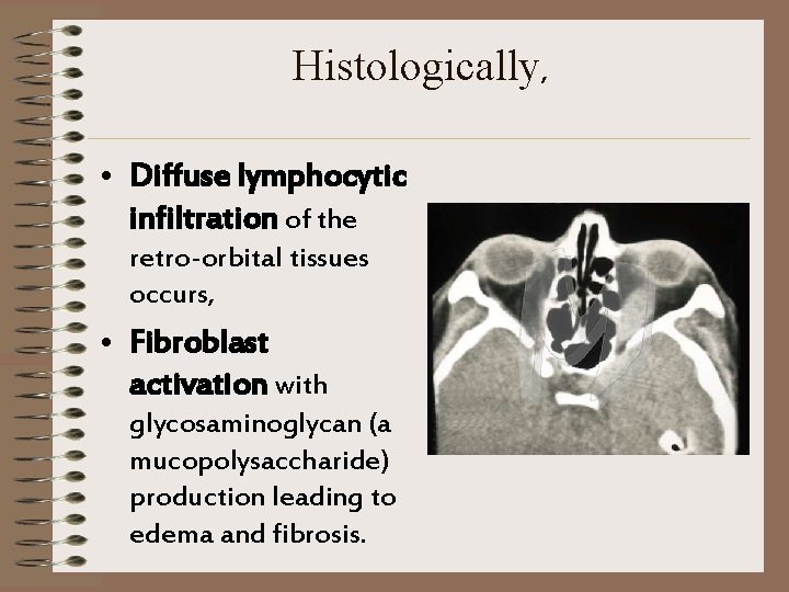Histologically, • Diffuse lymphocytic infiltration of the retro-orbital tissues occurs, • Fibroblast activation with