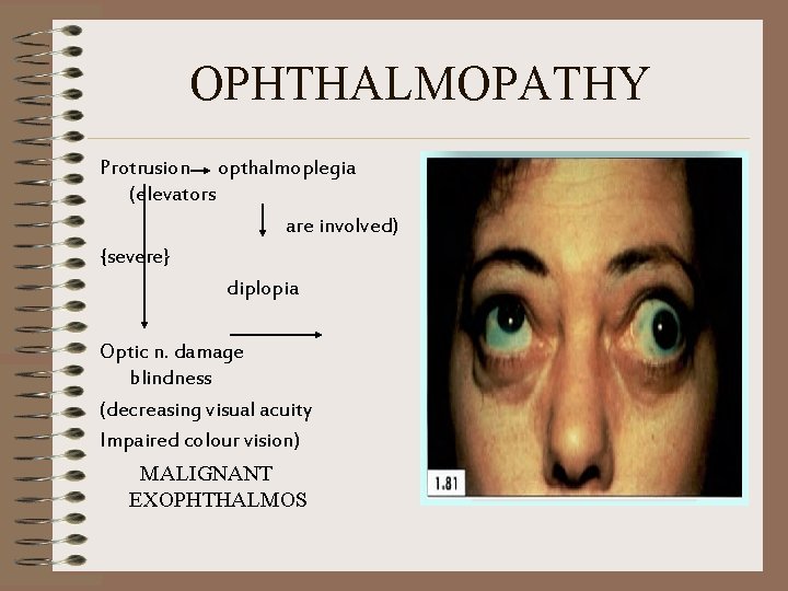 OPHTHALMOPATHY Protrusion opthalmoplegia (elevators are involved) {severe} diplopia Optic n. damage blindness (decreasing visual