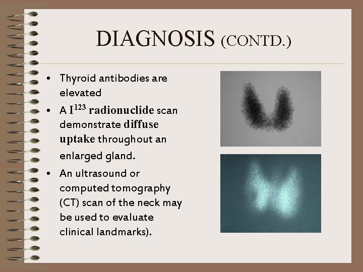 DIAGNOSIS (CONTD. ) • Thyroid antibodies are elevated • A I 123 radionuclide scan