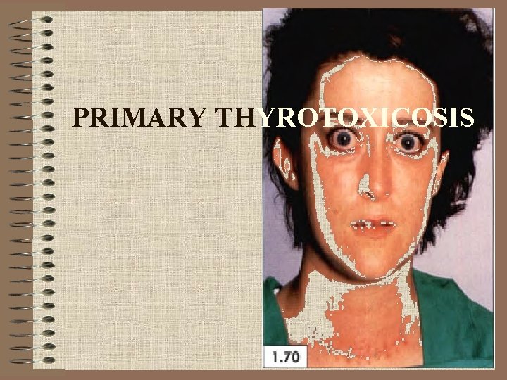 PRIMARY THYROTOXICOSIS 