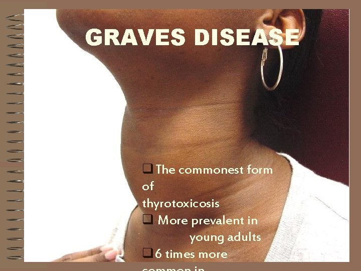 GRAVES DISEASE q. The commonest form of thyrotoxicosis q More prevalent in young adults