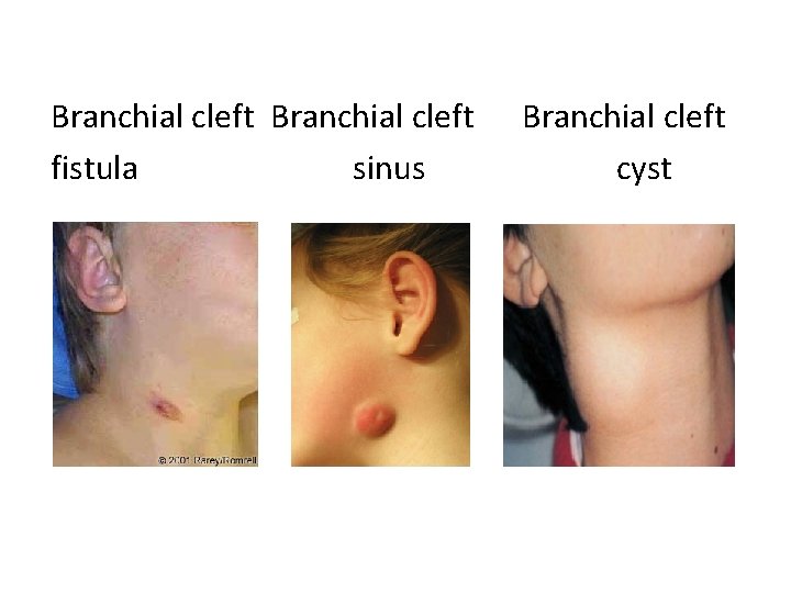 Branchial cleft fistula sinus Branchial cleft cyst 