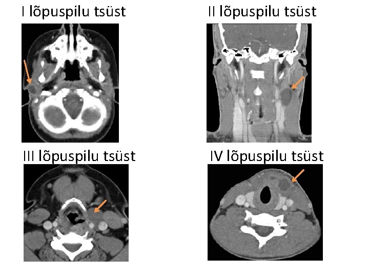 I lõpuspilu tsüst III lõpuspilu tsüst IV lõpuspilu tsüst 