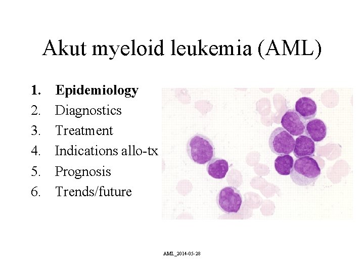 Akut myeloid leukemia (AML) 1. 2. 3. 4. 5. 6. Epidemiology Diagnostics Treatment Indications