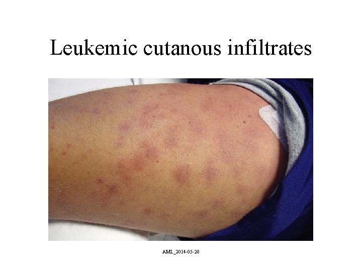 Leukemic cutanous infiltrates AML_2014 -05 -28 