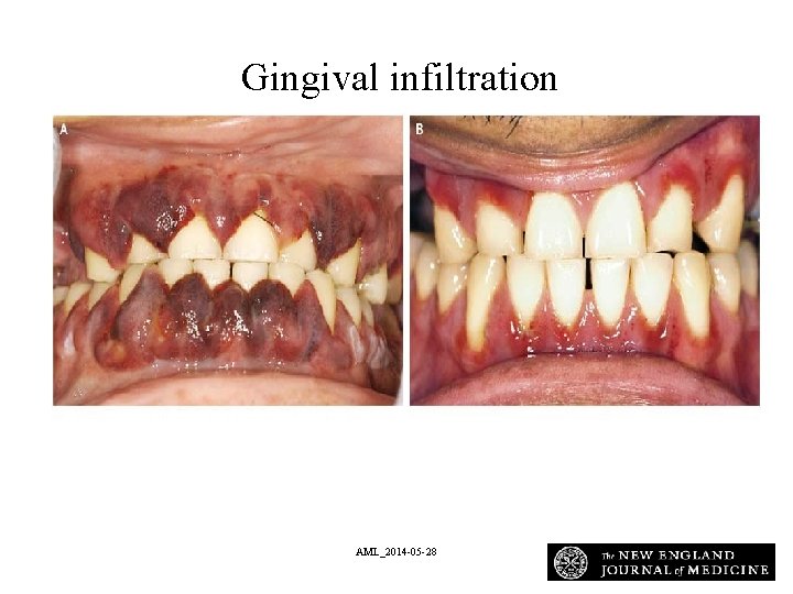 An Gingival infiltrationold Mani A and Lee D. N Engl J Med 2008; 358: