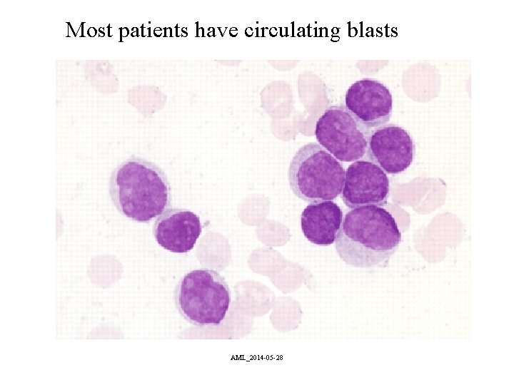 Most patients have circulating blasts AML_2014 -05 -28 